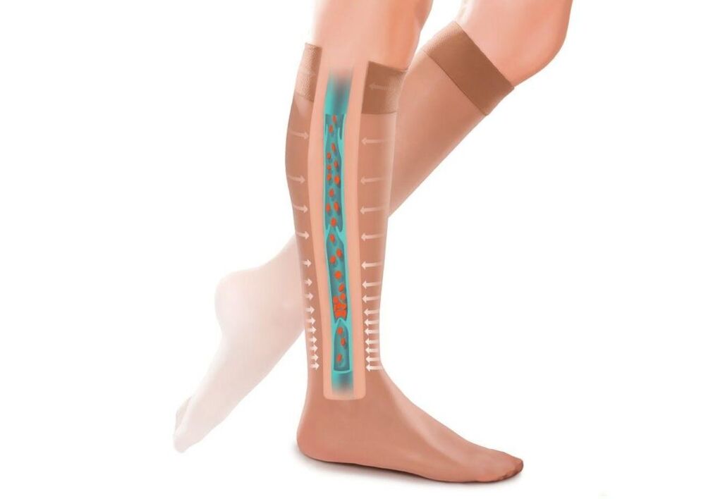 弹力袜对静脉曲张腿的影响