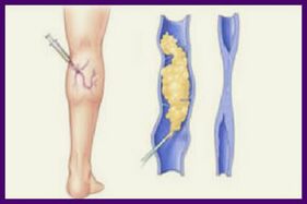 硬化疗法是摆脱腿部静脉曲张的流行方法