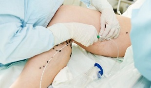 治疗女性腿部静脉曲张的方法